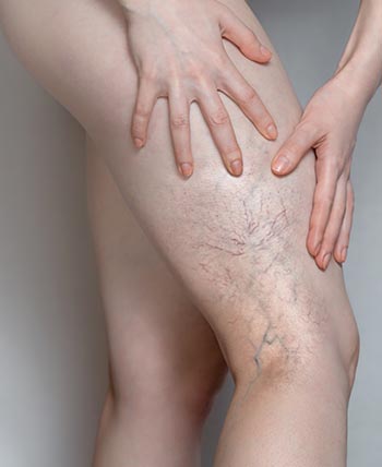 Spider Veins (Sclerotherapy) Near Me in Schaumburg, IL Spider Veins (Sclerotherapy) Near Me in Schaumburg, IL