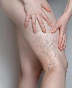 Spider Veins (Sclerotherapy) Near Me in Schaumburg, IL Spider Veins (Sclerotherapy) Near Me in Schaumburg, IL