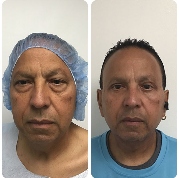Face Lift at Face Works Plastic Surgery, Plastic Surgeon Near Me in Schaumburg, IL Face Lift at Face Works Plastic Surgery, Plastic Surgeon Near Me in Schaumburg, IL