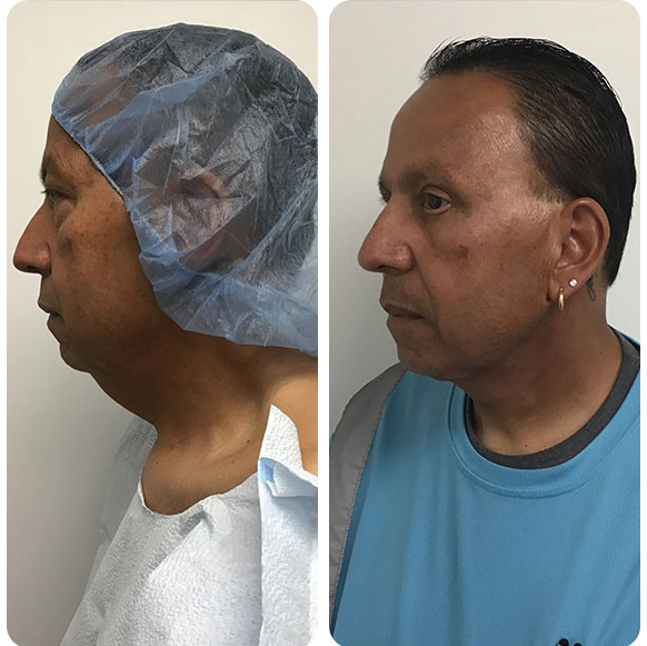 Face Lift at Face Works Plastic Surgery, Plastic Surgeon Near Me in Schaumburg, IL Face Lift at Face Works Plastic Surgery, Plastic Surgeon Near Me in Schaumburg, IL