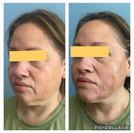 Thread Lift at Face Works Plastic Surgery, Plastic Surgeon Near Me in Schaumburg, IL