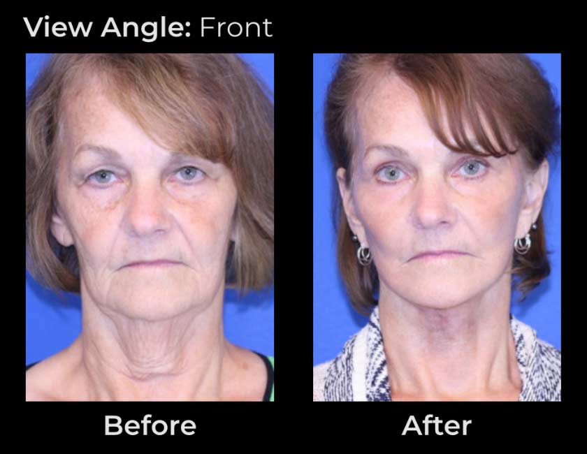 AwakeTight™ at Face Works Plastic Surgery, Plastic Surgeon Near Me in Schaumburg,