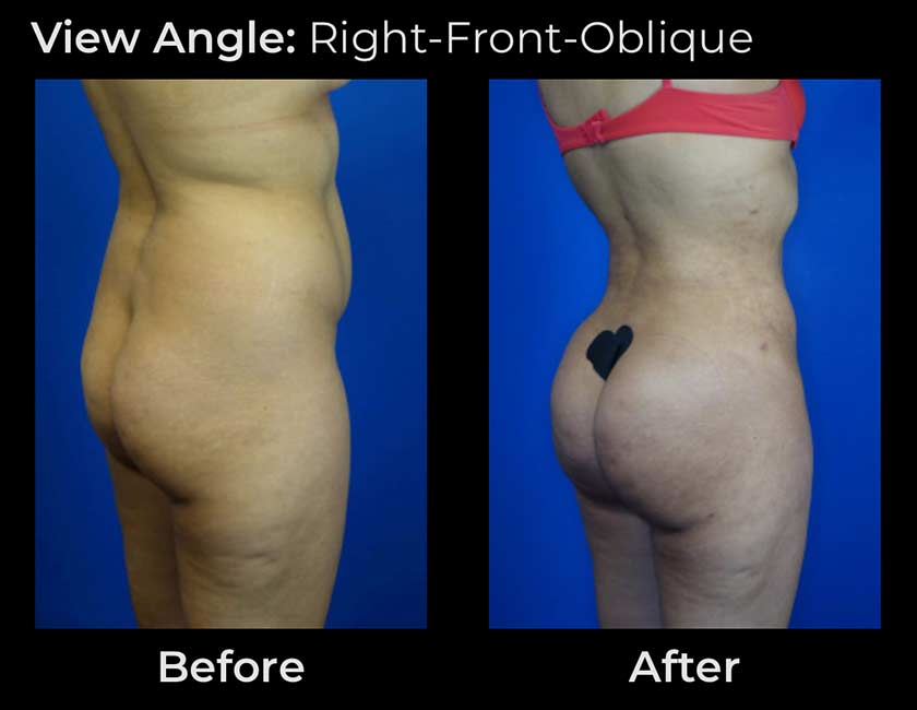 Brazilian Butt Lift at Face Works Plastic Surgery, Plastic Surgeon Near Me in Schaumburg, IL