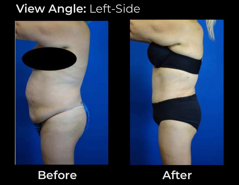 Tummy Tuck at Face Works Plastic Surgery, Plastic Surgeon Near Me in Schaumburg, IL