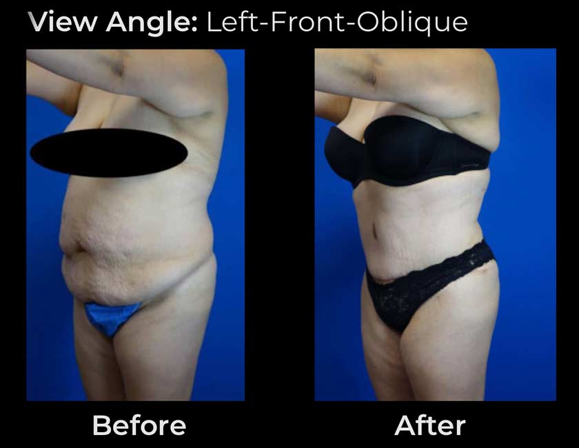 Tummy Tuck at Face Works Plastic Surgery, Plastic Surgeon Near Me in Schaumburg, IL