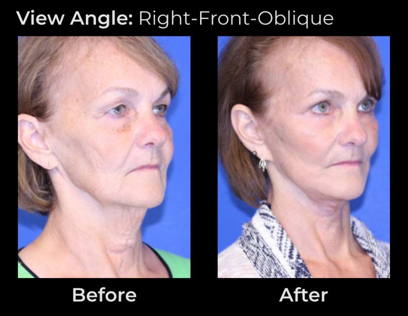 AwakeTight™ at Face Works Plastic Surgery, Plastic Surgeon Near Me in Schaumburg,
