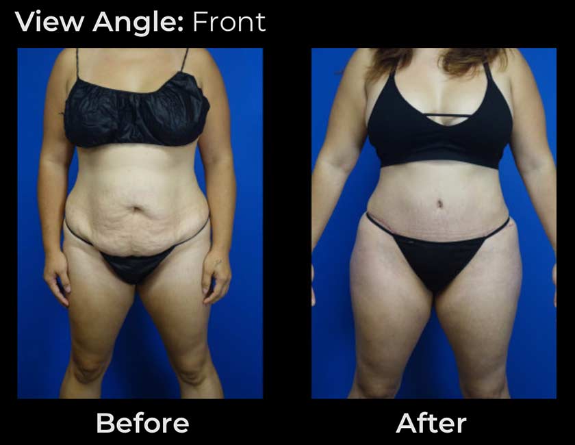 Tummy Tuck at Face Works Plastic Surgery, Plastic Surgeon Near Me in Schaumburg, IL