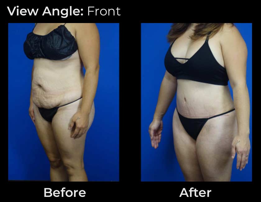 Tummy Tuck at Face Works Plastic Surgery, Plastic Surgeon Near Me in Schaumburg, IL