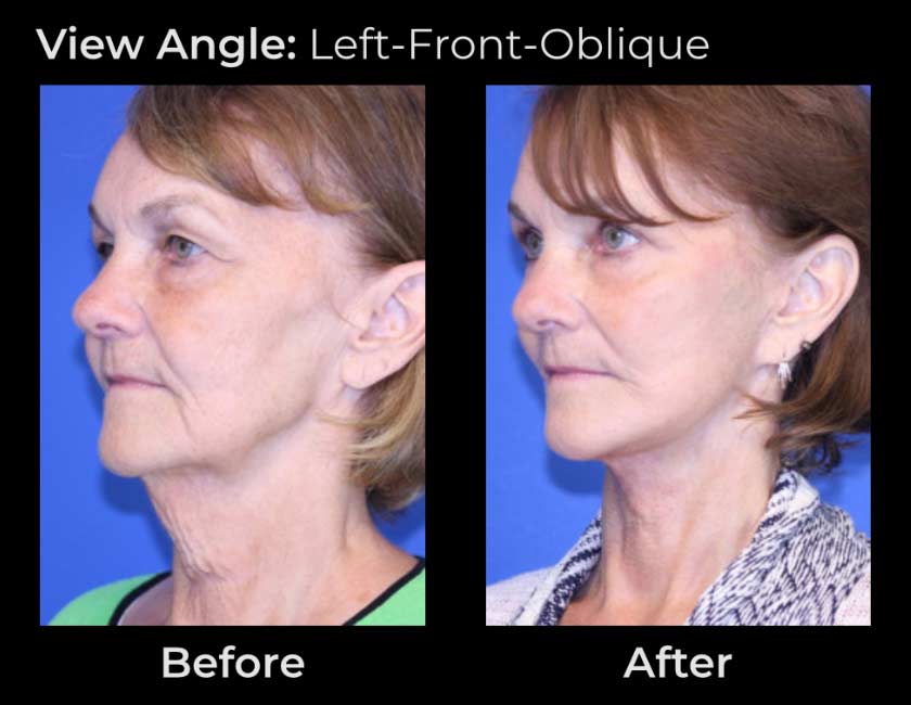 AwakeTight™ at Face Works Plastic Surgery, Plastic Surgeon Near Me in Schaumburg,