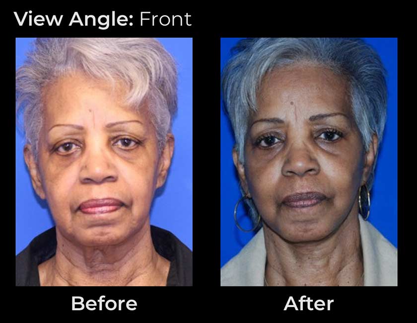 AwakeTight™ at Face Works Plastic Surgery, Plastic Surgeon Near Me in Schaumburg,
