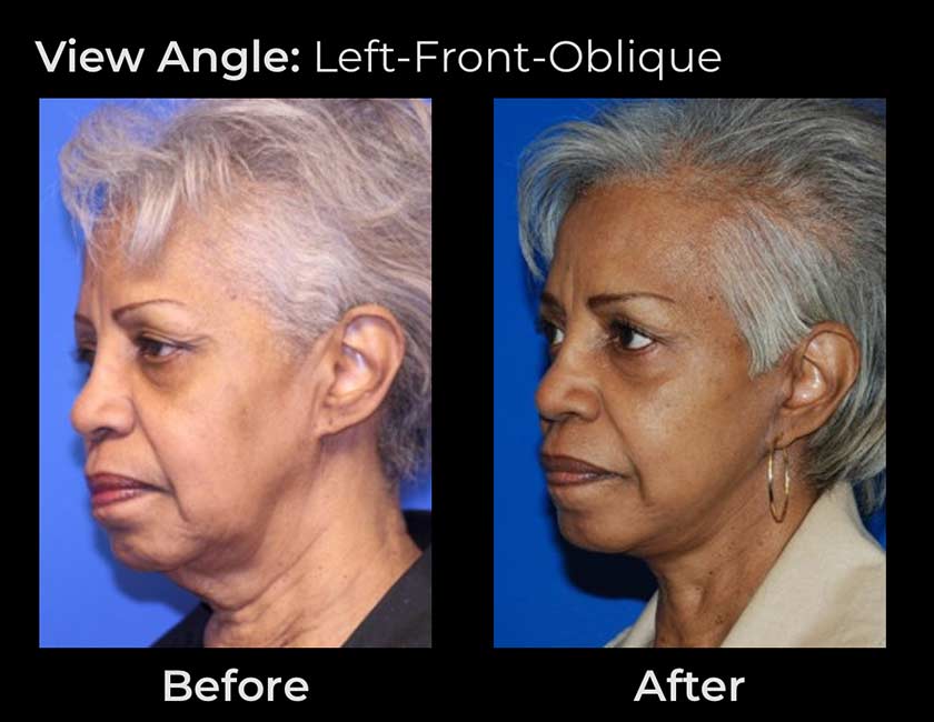 AwakeTight™ at Face Works Plastic Surgery, Plastic Surgeon Near Me in Schaumburg,