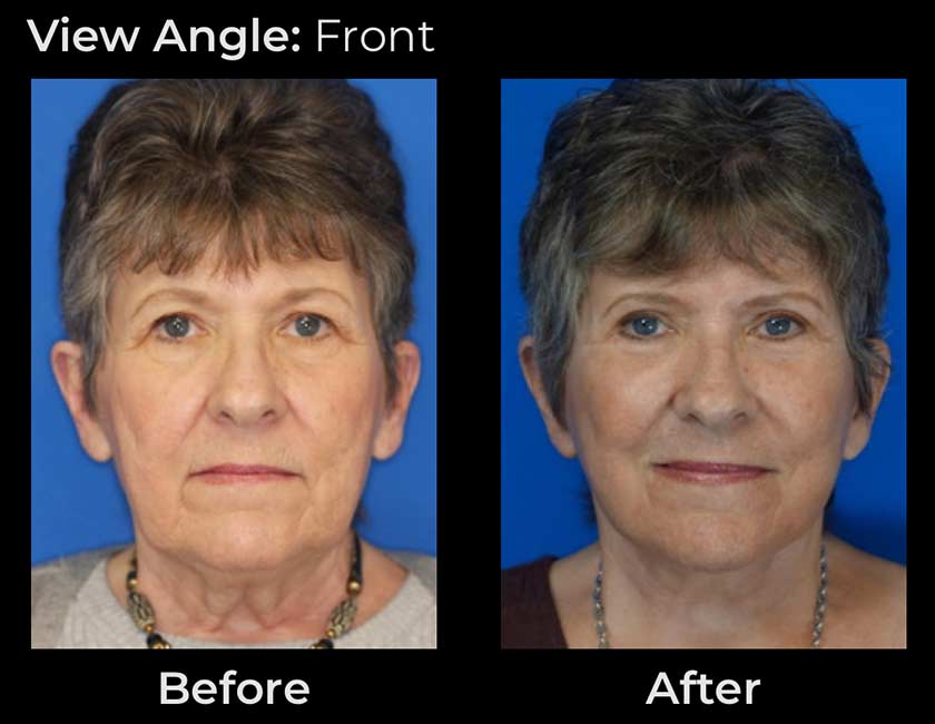 AwakeTight™ at Face Works Plastic Surgery, Plastic Surgeon Near Me in Schaumburg,