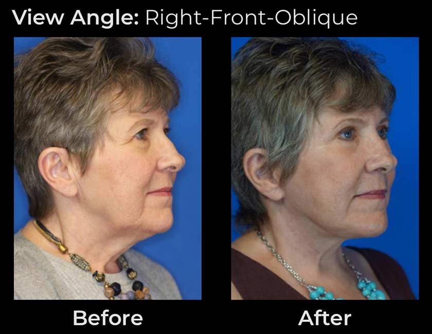 AwakeTight™ at Face Works Plastic Surgery, Plastic Surgeon Near Me in Schaumburg,