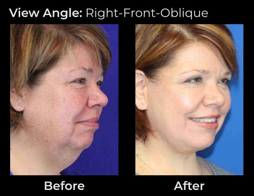 AwakeTight™ at Face Works Plastic Surgery, Plastic Surgeon Near Me in Schaumburg,