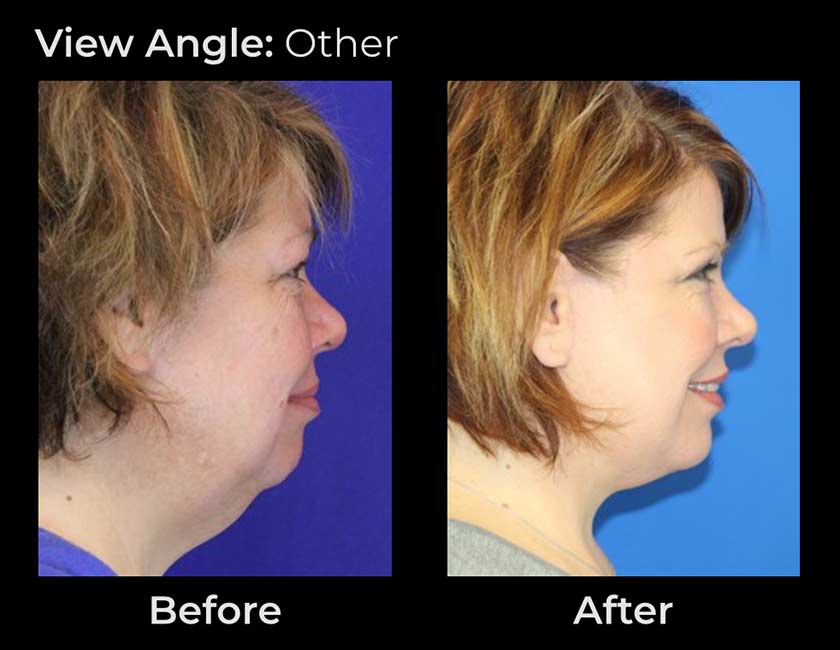 AwakeTight™ at Face Works Plastic Surgery, Plastic Surgeon Near Me in Schaumburg,