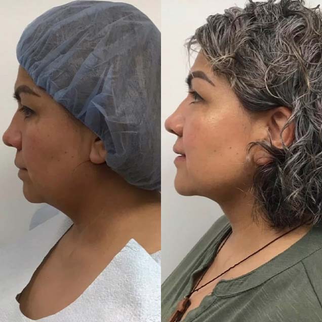 Before and After at Face Works Plastic Surgery, Plastic Surgeon in Schaumburg, IL Before and After at Face Works Plastic Surgery, Plastic Surgeon in Schaumburg, IL