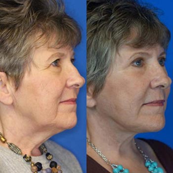 Before and After at Face Works Plastic Surgery, Plastic Surgeon in Schaumburg, IL Before and After at Face Works Plastic Surgery, Plastic Surgeon in Schaumburg, IL