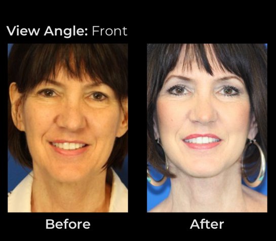 Eyelids Plastic Surgery at Face Works Plastic Surgery, Plastic Surgeon Near Me in Schaumburg, IL