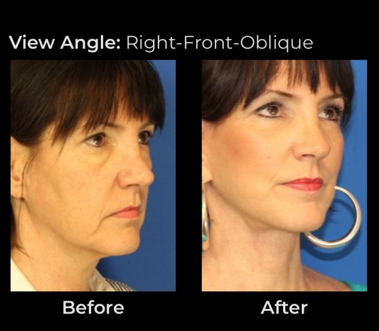 Eyelids Plastic Surgery at Face Works Plastic Surgery, Plastic Surgeon Near Me in Schaumburg, IL