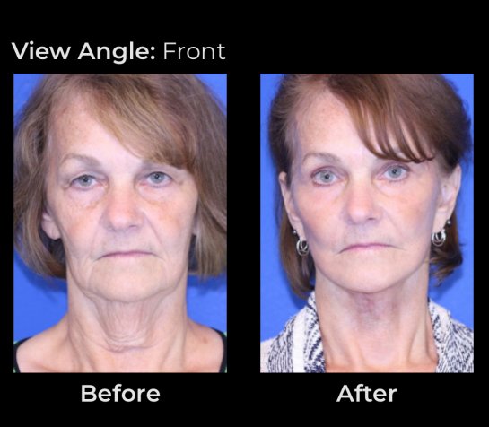 Eyelids Plastic Surgery at Face Works Plastic Surgery, Plastic Surgeon Near Me in Schaumburg, IL