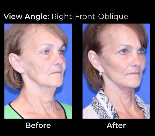 Eyelids Plastic Surgery at Face Works Plastic Surgery, Plastic Surgeon Near Me in Schaumburg, IL