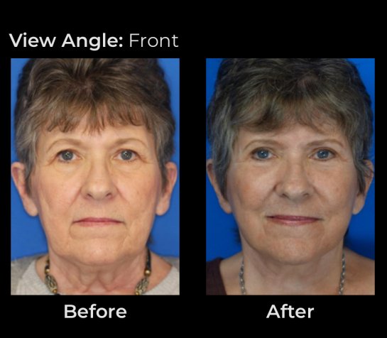 Eyelids Plastic Surgery at Face Works Plastic Surgery, Plastic Surgeon Near Me in Schaumburg, IL