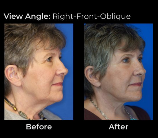 Eyelids Plastic Surgery at Face Works Plastic Surgery, Plastic Surgeon Near Me in Schaumburg, IL
