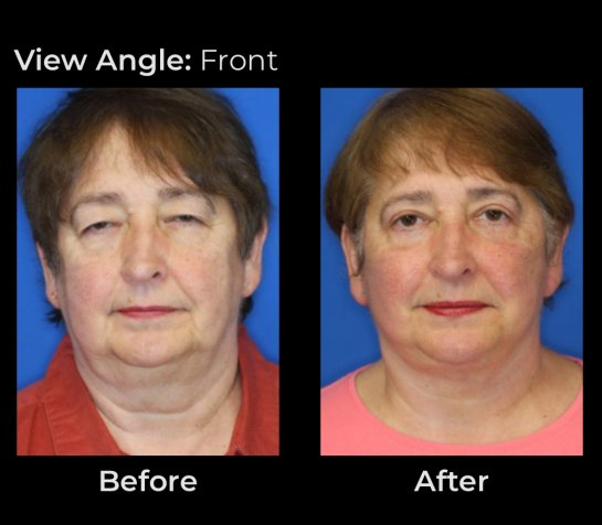 Eyelids Plastic Surgery at Face Works Plastic Surgery, Plastic Surgeon Near Me in Schaumburg, IL