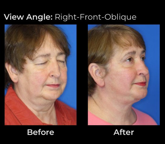 Eyelids Plastic Surgery at Face Works Plastic Surgery, Plastic Surgeon Near Me in Schaumburg, IL