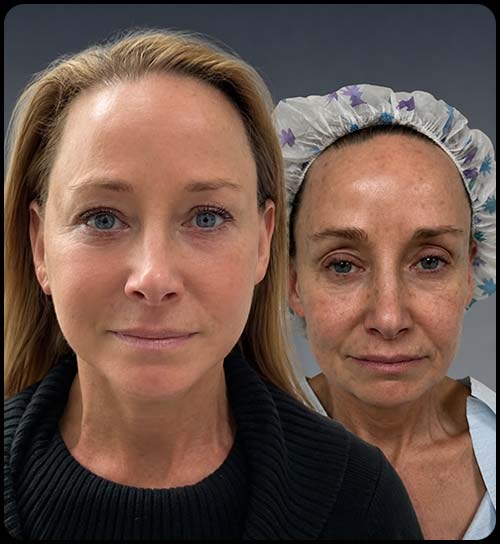 Before and After at Face Works Plastic Surgery, Plastic Surgeon in Schaumburg, IL Before and After at Face Works Plastic Surgery, Plastic Surgeon in Schaumburg, IL