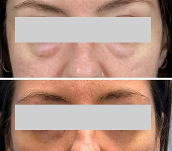 Eyelids Plastic Surgery at Face Works Plastic Surgery, Plastic Surgeon Near Me in Schaumburg, IL
