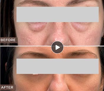 Eyelids Plastic Surgery at Face Works Plastic Surgery, Plastic Surgeon Near Me in Schaumburg, IL