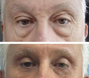 Before and After Eyelids Plastic Surgery at Face Works Plastic Surgery, Near Me in Schaumburg, IL