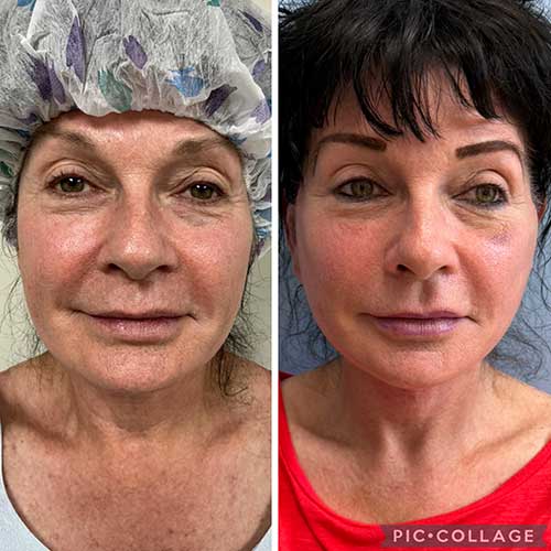 Before and After Face & Neck Lift at Face Works Plastic Surgery Near Me in Schaumburg, IL