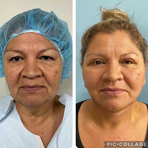 Before and After Face & Neck Lift at Face Works Plastic Surgery Near Me in Schaumburg, IL