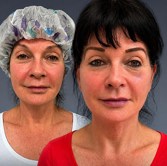 AwakeTight™ at Face Works Plastic Surgery, Plastic Surgeon Near Me in Schaumburg,